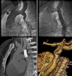 aortic-286x300 Лечение коарктации аорты у детей в Израиле