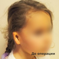 2149706781 Микротия у детей. Реконструкция уха с помощью имплантата Medpor.